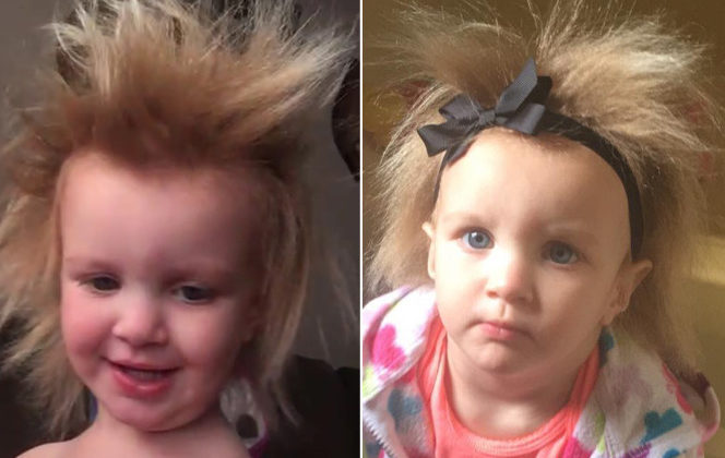 hair-disorder-feature